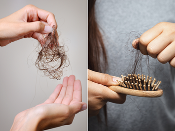 5 Expert Solutions for Hair Loss: Regain Your Confidence & Healthy Hair