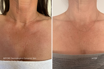 Before After Dermalogica Dynamic Skin Sculptor Body Serum