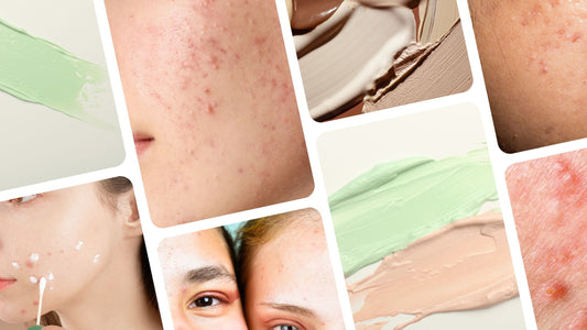 Experts Share Makeup Tips for Acne-Prone Skin
