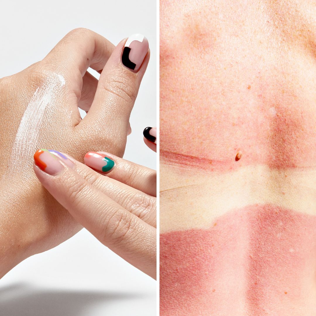 SPF factors explained to stop skin burning. Image of SPF texture and burnt skin