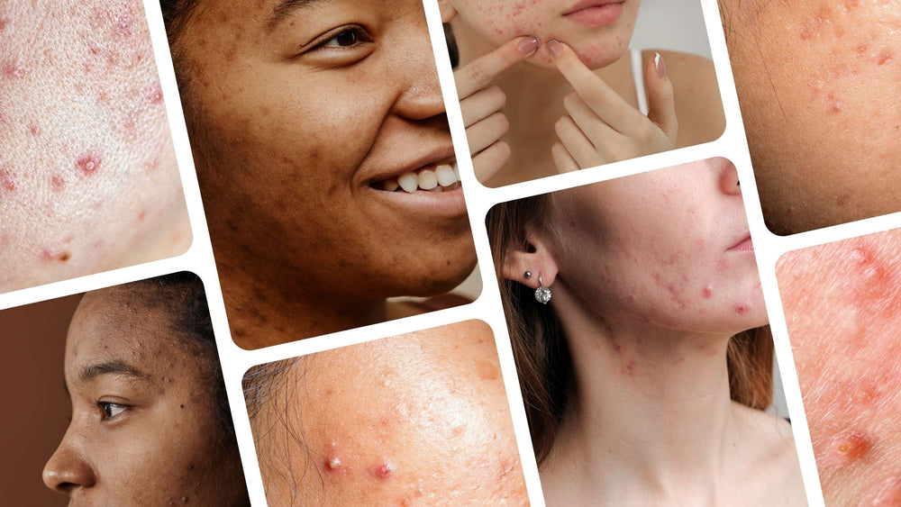 Understanding Acne and The Expert Tips You Need To Control It