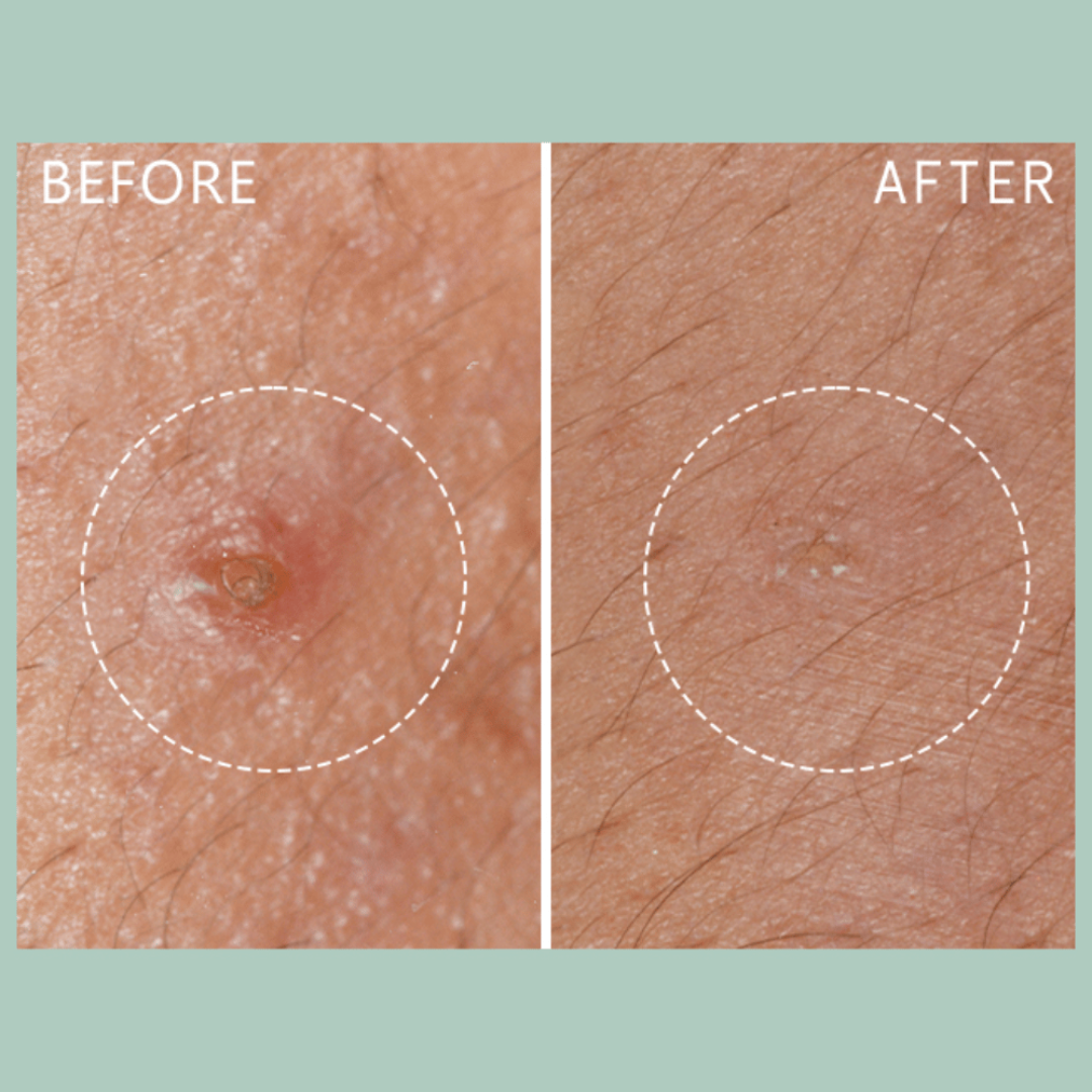 Lierac Anti-Blemish Protocol The Stop Spots