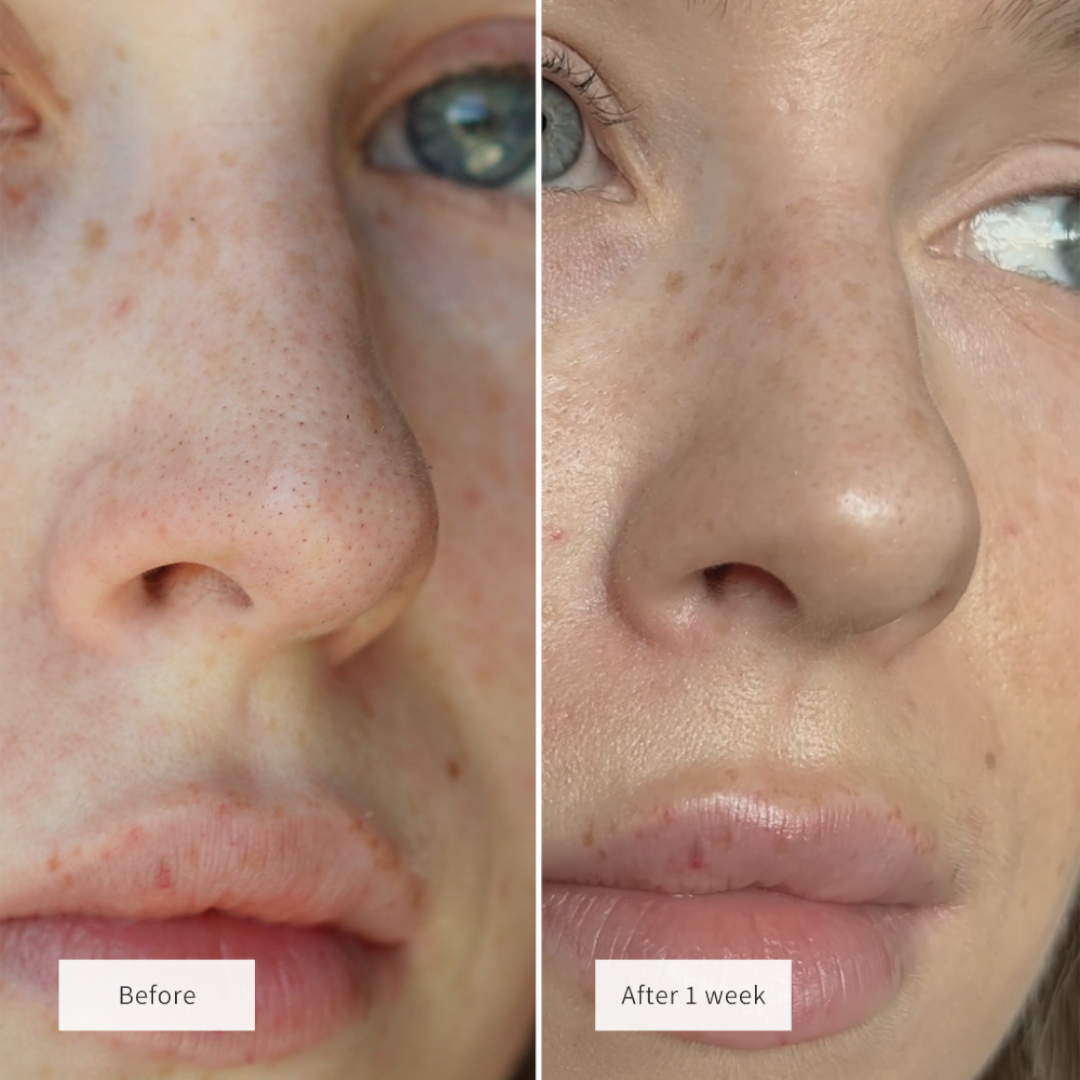 Vue Nose Patches
