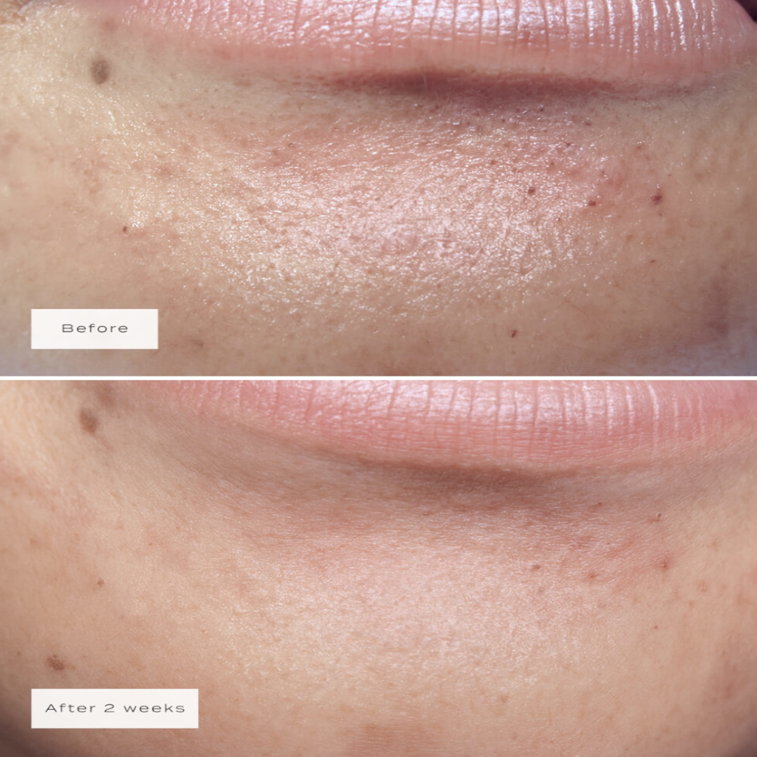 Vue Chin Patches